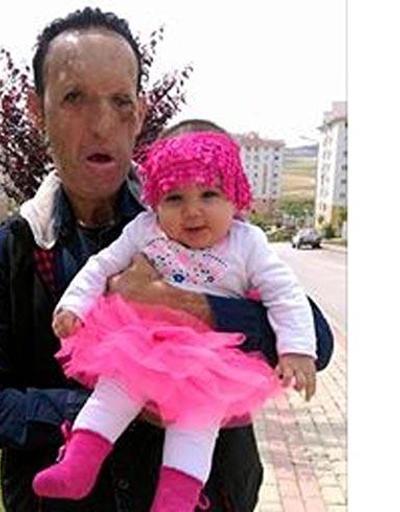 Yüz nakli olan baba kızıyla fotoğrafını paylaştı