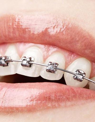 Diş telleri hakkında doğru bilinen yanlışlar