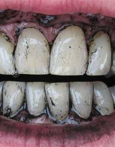 Kömürün dişleri beyazlattığına dair hiçbir bilimsel kanıt yok