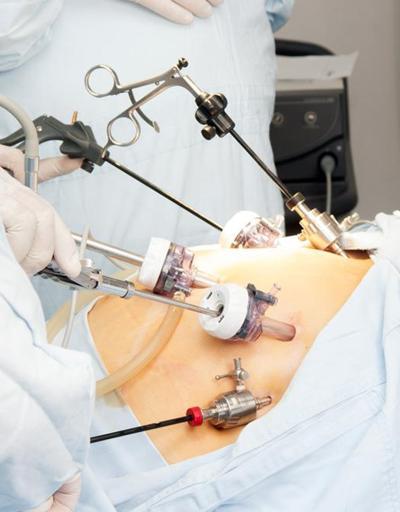 Laparoskopik obezite cerrahisi nasıl yapılır