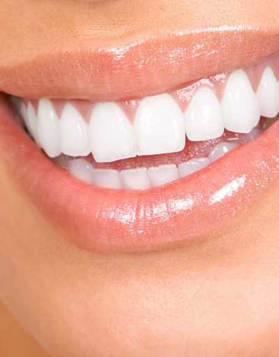 Dişler arasındaki boşluklar nasıl kapanır