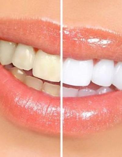 Bu yöntem ile 10 dakikada daha beyaz dişlere sahip olunabilir