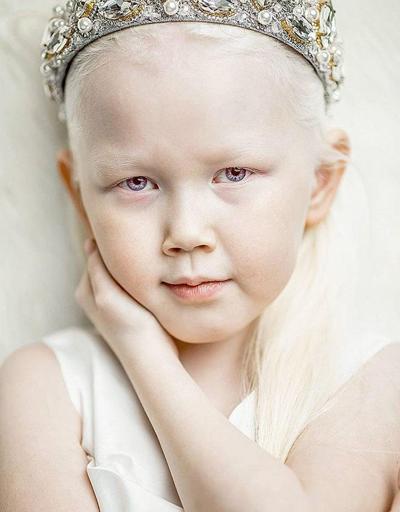 Modellik ajansları Sibiryalı albino hastası kızın peşinde