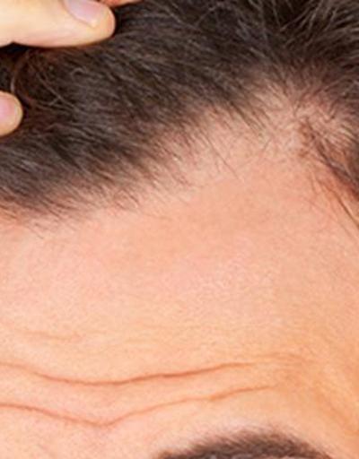 Saç dökülmesi: Nedenleri ve tedavisi nelerdir