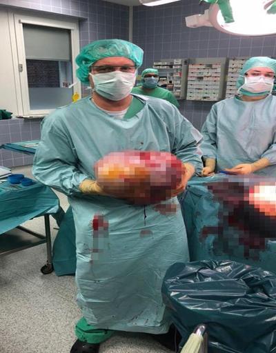 İkiz bebek sandılar: Karnından tümör çıktı