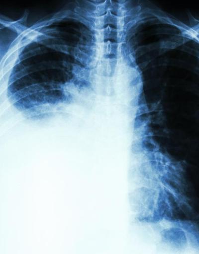Sigara içenlerin yanında olmak akciğer kanseri riskini artırıyor