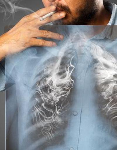 Uzmanlar: Akciğer kanserinin yüzde 90ı sigaradan
