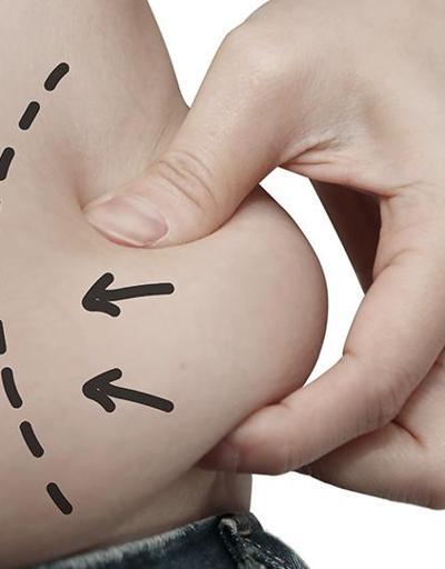Liposuction nedir, en çok hangi bölgelere uygulanır