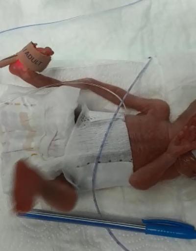 Türkiye’de bir ilk 285 gram doğan Elçin bebek hayata tutundu