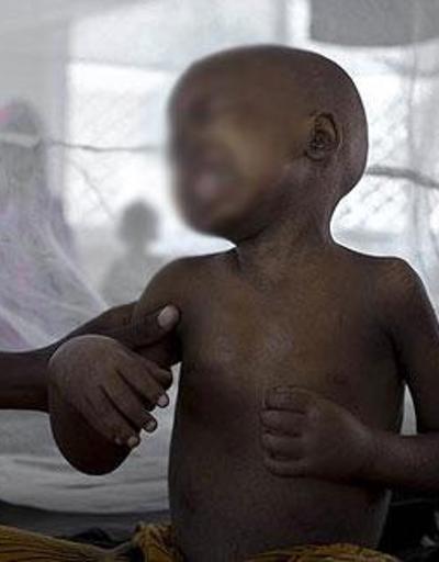 Etiyopyada kolera salgını: 16 ölü