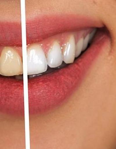 Dişlerde oluşan sararmalar kabusunuz olmasın