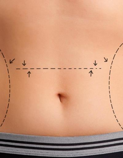 Liposuction zayıflama yöntemi değildir