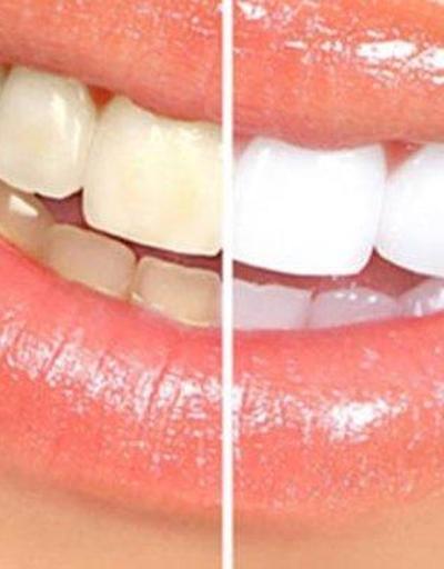 Diş beyazlatma işlemi dişlere zarar verir mi