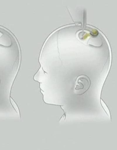 Son Dakika: Muskın beyin kontrol eden çipi Neuralinkten korkmalı mıyız | Video