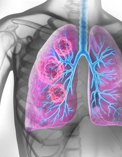 Akciğer kanserinin en önemli belirtisi