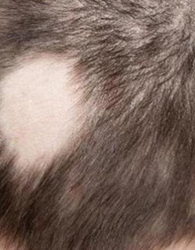 Saçkıran (Alopesi Areata) Nedir Saçkıranın Belirtileri Nelerdir, Tedavisi Nasıl Yapılır