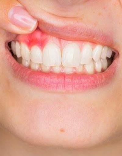 Diş Eti Kanaması Abdesti Bozar Mı Diş Etinde Kanama Olan Kişinin Abdesti Bozulur Mu