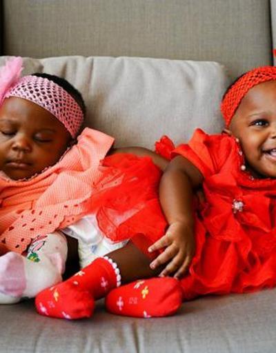 Kamerunlu siyam ikizleri, Türkiyede şifa buldu