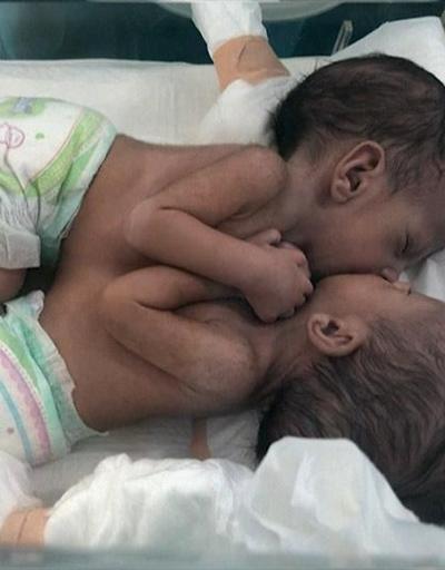 Yemenli yapışık ikizlerden haber var