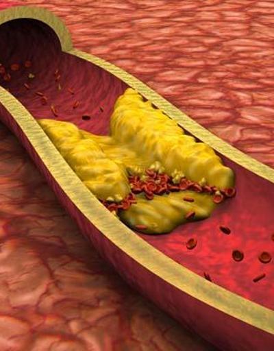 Kolesterolün ilk belirtisi parmaklarda ortaya çıkıyor