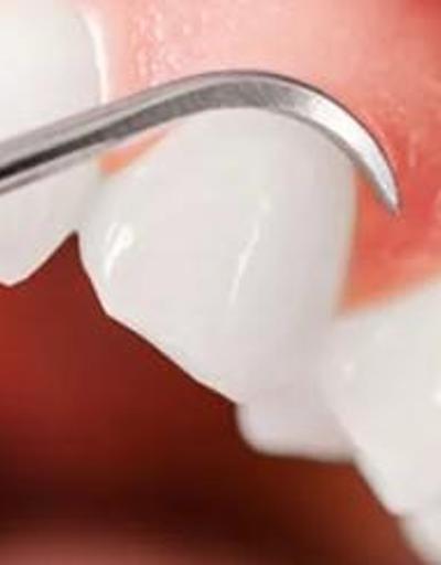 Diş eti hastalıkları diş kaybına neden oluyor