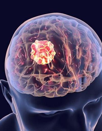 Uzmanı uyardı: Belirti vermeden ilerleyen beyin tümörlerine dikkat