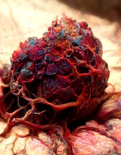Karaciğer kanseri vücuda yayılması durumunda tedavi edilebilir mi