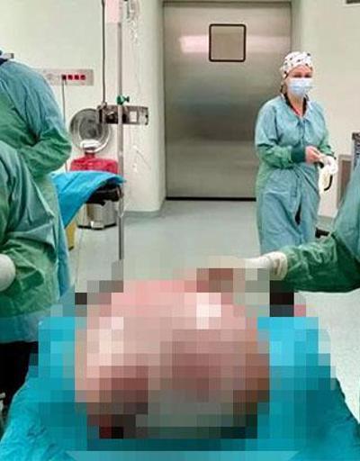 Doktorlar bile inanamadı: Karnından 35 kiloluk kitle çıkarıldı