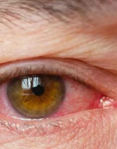 Gözdeki Hastalıklar Nelerdir Göz İle İlgili Hastalıklar Listesi...