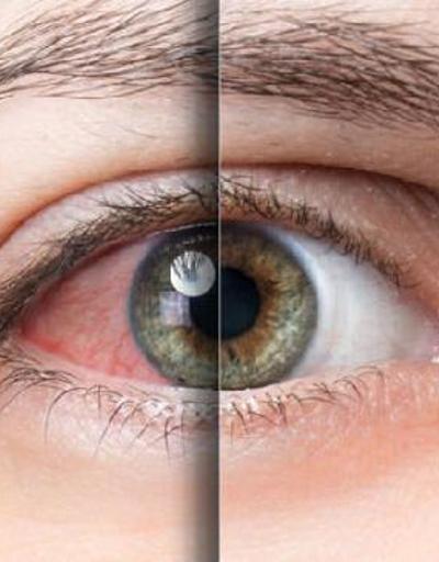 “Mevsimsel alerjiler, en çok gözleri etkiliyor”