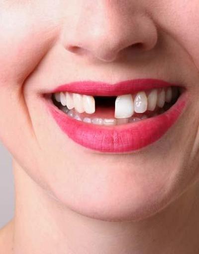 Eksik dişler birçok soruna yol açıyor