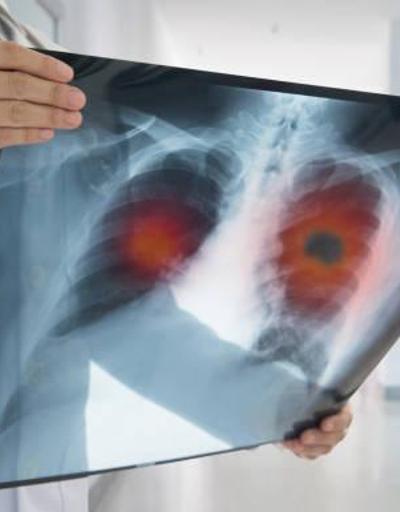 Akciğer kanserine karşı 7 önlem Kimler risk altında