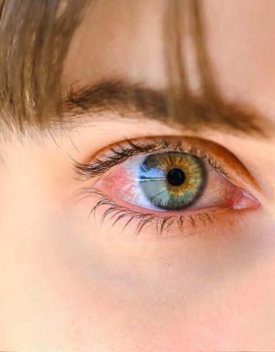 Göz sulanmasını hafife almayın Görmeyi tehdit eden hastalıkların habercisi olabilir