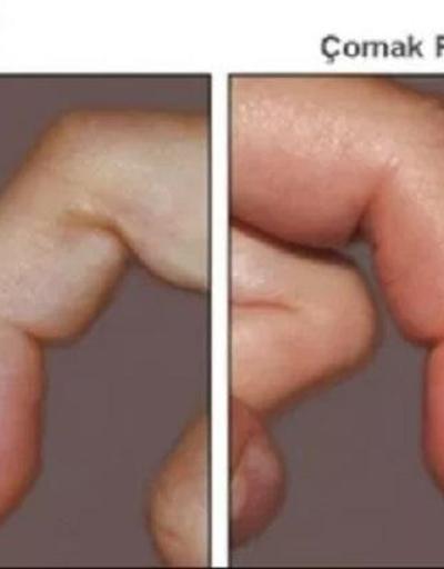 Böyle görünüyorsa dikkat Parmağınızı hemen kontrol edin, kanser belirtisi olabilir