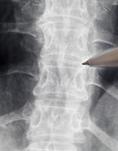 Türkiyede çok üst düzeyde yapılıyor Uzman isimden dikkat çeken açıklama: “Teknolojinin ilerlemesi omurga cerrahisindeki riskleri en aza indirdi”