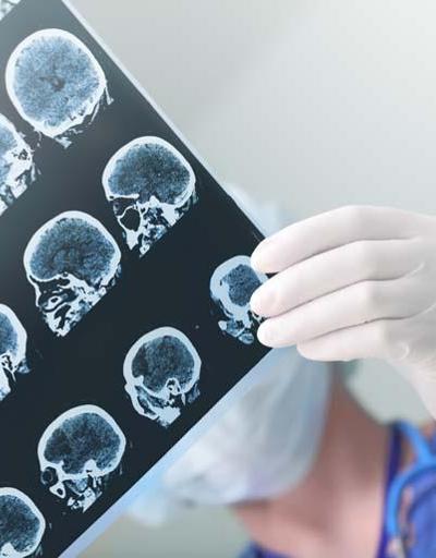 Epilepsi ile ilgili doğru bilinen yanlışlar Çalışmaya engel mi, tedavisi nasıl