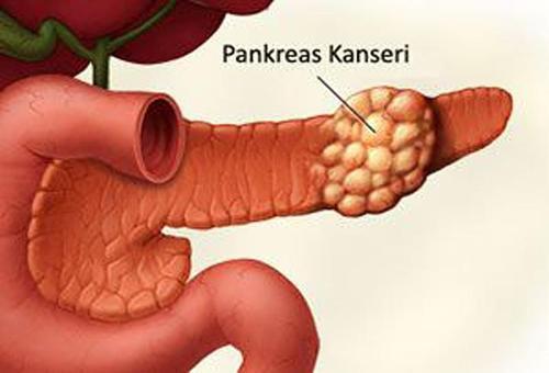 Pankreas kanserinin erken teşhisinde önemli ilerleme