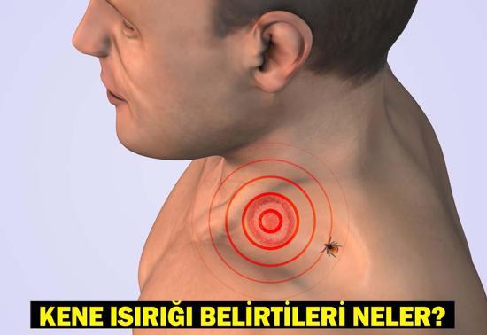 KENE ISIRIĞI BELİRTİLERİ: Kene ısırığı nasıl belli olur Kene ısırığında ilk yapılması gereken nedir Keneden korunmak için ne yapmalıyız