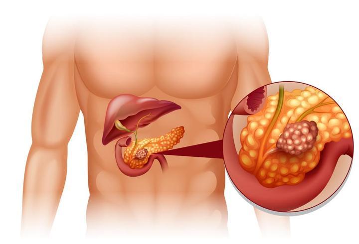 Pankreas Ağrısı Nasıl Olur? Pankreas Ağrısı Hangi Hastalıkların Belirtisi Olabilir?