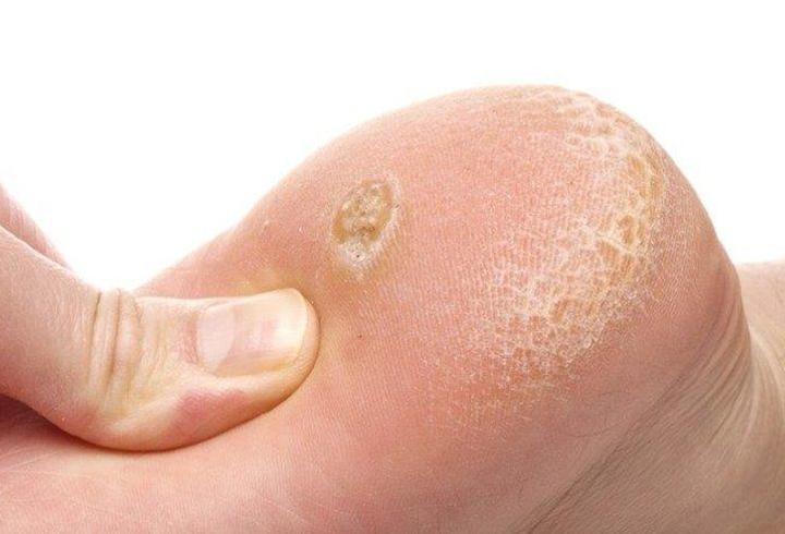 Nasır İçin Hangi Doktora Gidilir? Nasır İçin Hangi Bölüme Gidilmelidir?