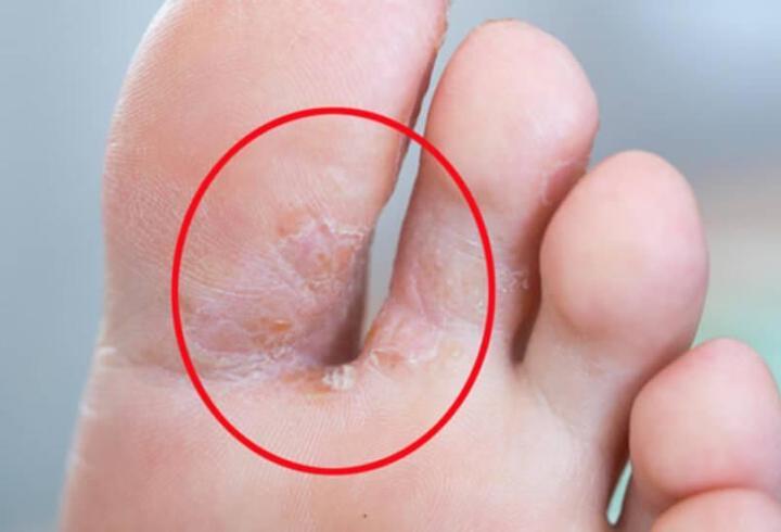 Kalp ve Damar Cerrahisi Uzmanı Op. Dr. İlknur Cihan, varis tedavisinde amacın yalnızca görüntüyü düzeltmek olmadığını; şikayetleri azaltmak ve hastalığın ilerlemesini önlemek için doppler ultrason bulgularına göre kişiye özel planlama yapılması gerektiğini vurguladı.1