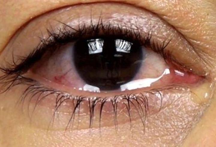 Göz Sulanması Nedir, Neden Olur? Göz Yaşarması Nasıl Geçer, Tedavisi Nasıl Yapılır?