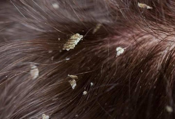 Seboreik Dermatit Nedir, Belirtileri Nelerdir? Seboreik Dermatit Tedavisi Nasıl Yapılır?