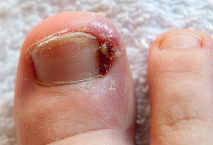 Tırnak Batması İçin Hangi Doktora Gidilir? Tırnak Batmasına Hangi Bölüm Bakar?