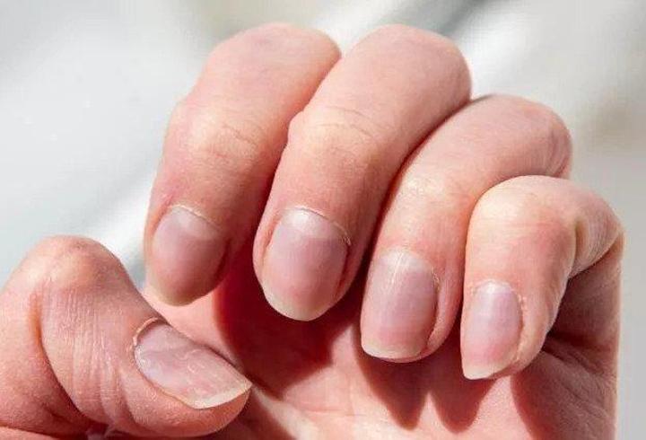 Tırnak sağlığını ihmal etmeyin! Tırnak İçin Hangi Doktora Gidilir? Tırnak Hastalıklarına Hangi Bölüm Bakar?
