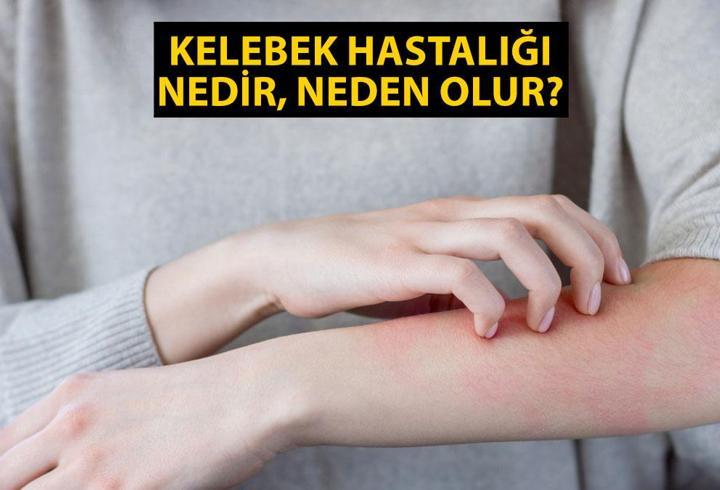 Kelebek hastalığı (Epidermolysis Bullosa) nedir, belirtileri neler, neden olur, bulaşıcı mı?