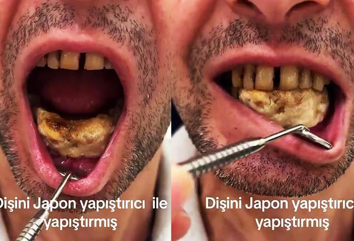 Video Haber | Kendinizin doktoru olmayın! Dişlerini Japon yapıştırıcısı sürdü!