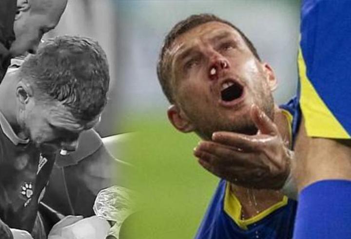Fenerbahçe Kaptanı Edin Dzeko'nun burnu kırıldı