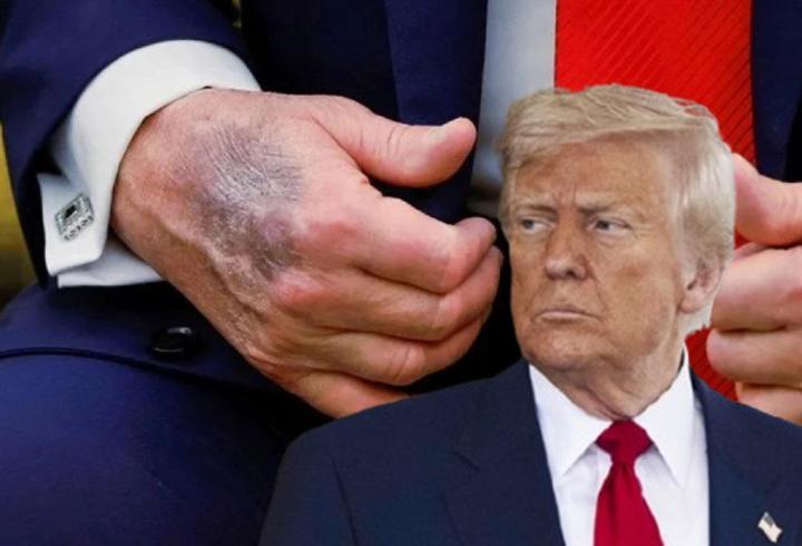 Trump’ın elindeki morluk yine olay oldu!