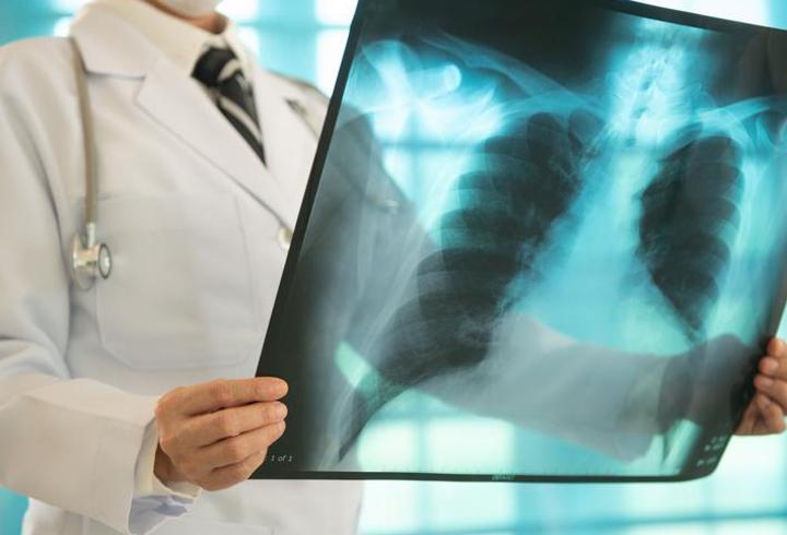 Erken tanı hayati önem taşıyor! Akciğer kanserinin belirtileri ne? "Öksürük, göğüs ağrısı, halsizlik, kanlı balgam..."